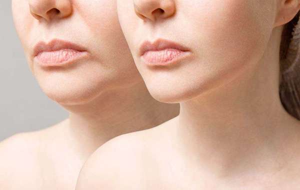 Say Goodbye to Wrinkles: The Power of Dermal Fillers for Smoother Skin