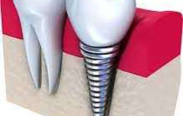 The Treatment of Dental Implant Position