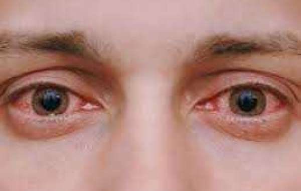 Heading: Understanding Common Eye Problems and Their Management