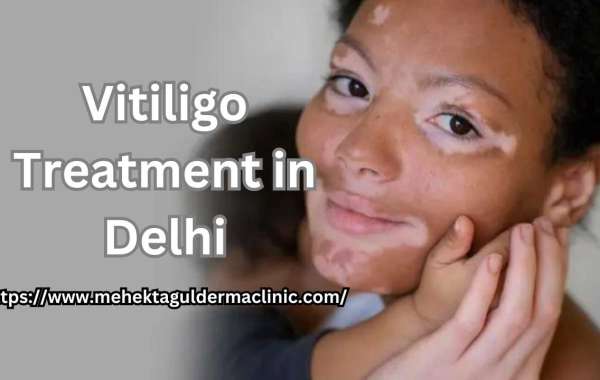 What are the best treatments for vitiligo?